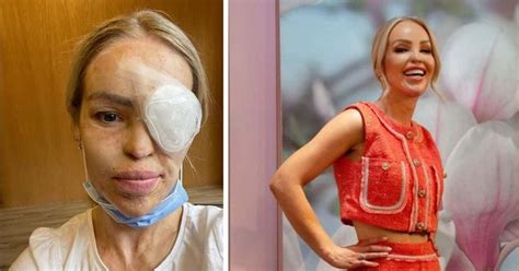 Katie Piper Rushed To Hospital As Effects Of Horrifying 2008 Acid Attack Continue To Manifest