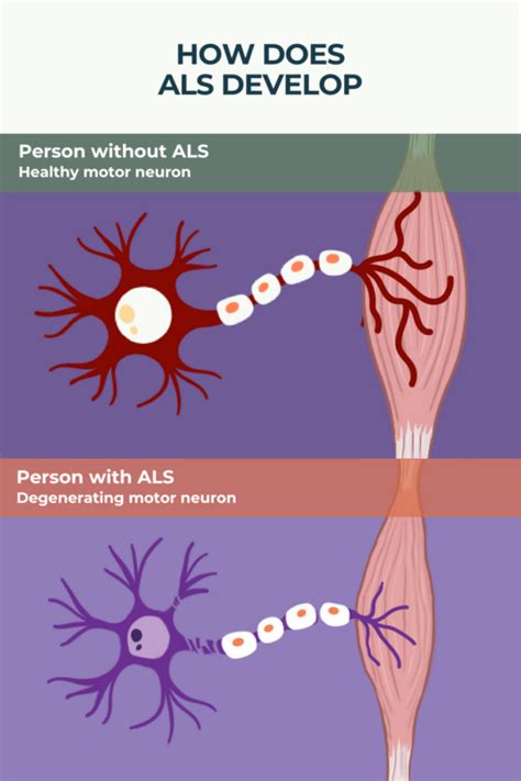 What Is Amyotrophic Lateral Sclerosis Als Als News Today