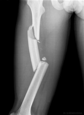 Playlist Femoral Shaft Fracture By Najib