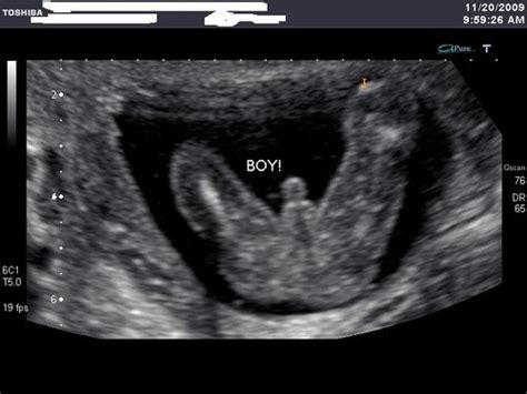 See more ideas about ultrasound pictures, new baby products, ultrasound. 18-20 week ultrasound pictures - Page 2 - BabyCenter