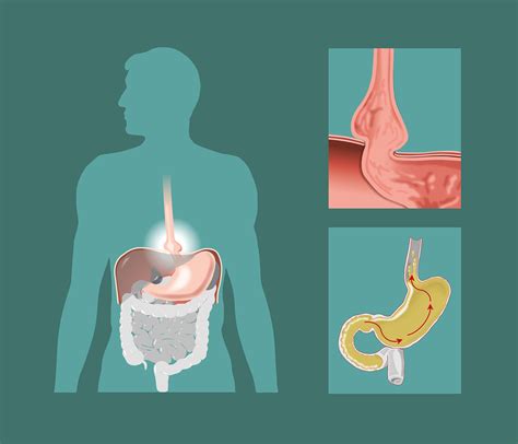 Hiatus Hernia