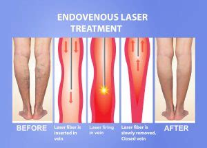 If you choose to directly pay for your services (fee for. What To Expect From Endovenous Laser Treatment For ...