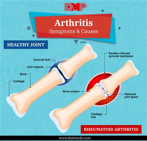 Arthritis And Its Different Types Blog By Datt Mediproducts