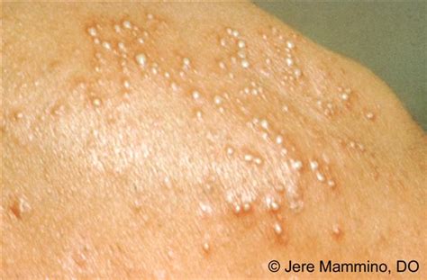 Folliculitis American Osteopathic College Of Dermatology Aocd