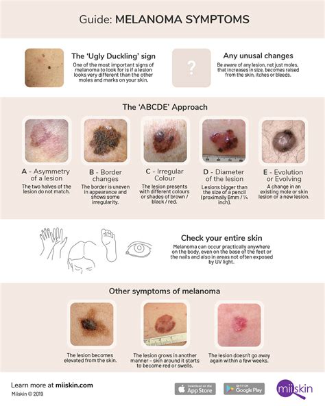 Melanoma Skin Cancer Diagram The Best Porn Website