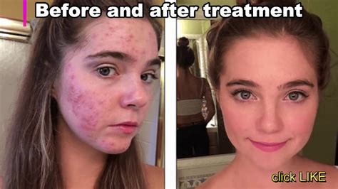 Cystic Acne What Is It Warning Pimple Popping Youtube