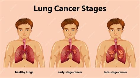 Free Vector Informative Illustration Of Lung Cancer Stages