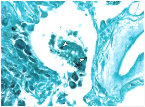 Pneumocystis Jiroveci Pneumonia High Resolution Ct Findings In