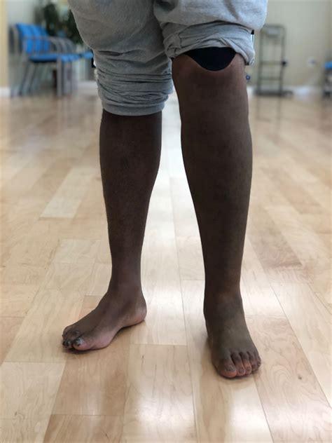 Prosthetic Silicone Skin For Amputees Prosthetic Leg Leg Prosthesis