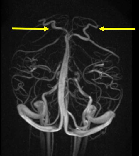 Superior Sagittal Sinus Pacs