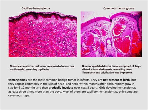 Quick Pattern Diagnosis Hemangioma Dr Sarmas Dermpath And Other