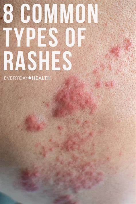 Skin Rash Identification Chart Adults