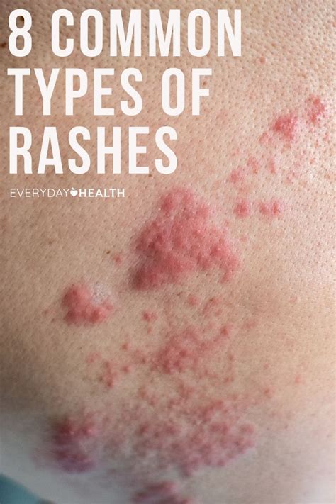 8 Common Types Of Rashes Types Of Rashes Common Skin Rashes Types