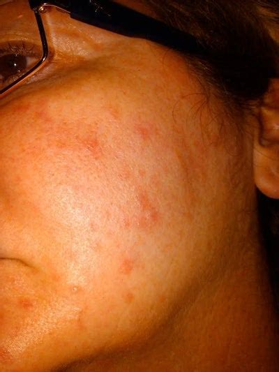 Red Spots On Face From Sun Or Heat Exposure What Is The Cause Photo