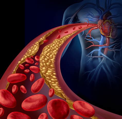 Atherosclerosis Symptoms Risk Factors And Health Complications