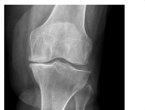 Severe Knee Oa And Radiological Changes In This Left Knee Radiography
