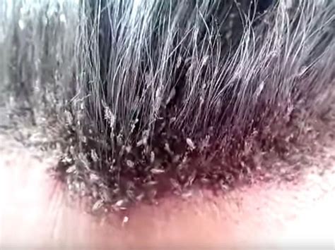 Fleas Vs Lice In Human Hair