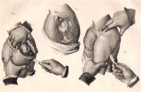 2 thoughts on the gentleman's guide to amputation. Surgery, Amputation, Pancoast, 1846