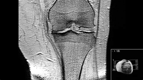 What Does Arthritis Look Like On An MRI