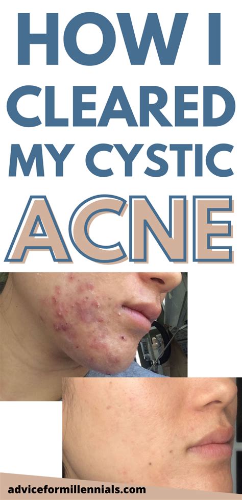 How I Cleared My Cystic Acne Without Accutane Hormonal Acne Treatment Bad Acne Acne Treatment