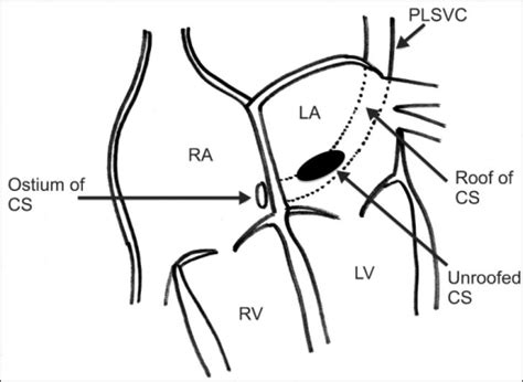 A Schematic View Of This Case The Morphologic Type Of Open I