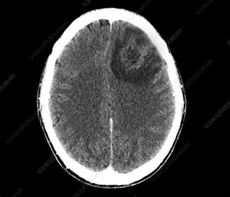 Brain Abscess Ct Scan Stock Image C0529309 Science Photo Library