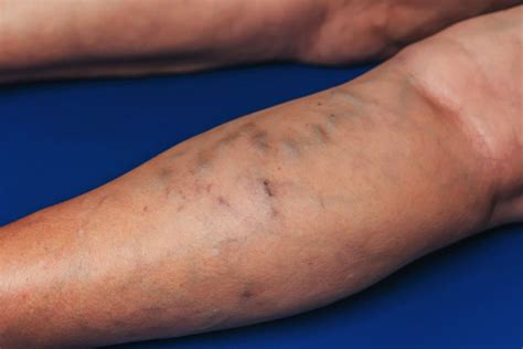 What Is Phlebitis And Whats The Best Treatment Vascular Solutions