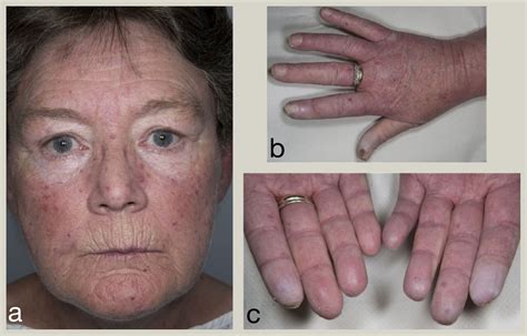 Systemic Sclerosis Clinical Features And Management Medicine