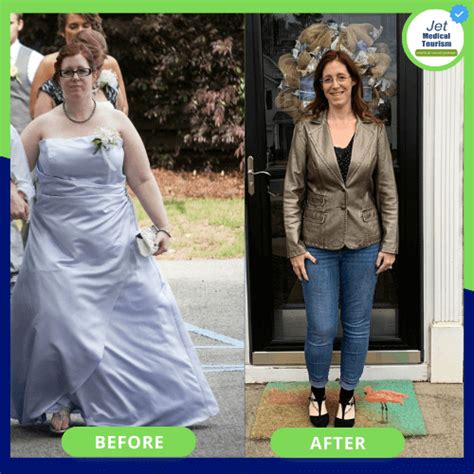 Gastric Bypass Before And After Pictures And Photos 2022
