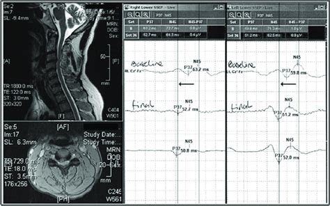 Intraoperative Ssep Recording During Surgical Decompression For