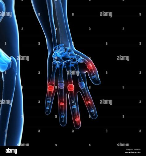 X Ray Hand Arthritis Stock Photo Alamy