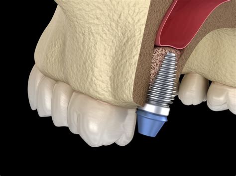 Recovering From Your Dental Bone Graft Procedure