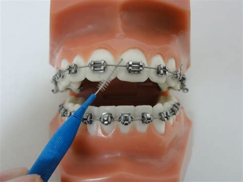 Peut On Faire De La Boxe Avec Un Appareil Dentaire - Hygiène dentaire au quotidien : "Gardez vos dents propres tout au long