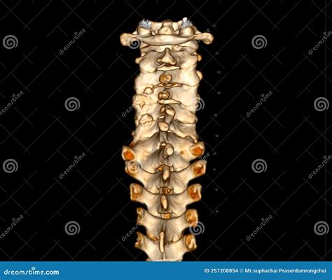Cervical Fracture And Human Spine And Vertebrae Damage Outline Diagram