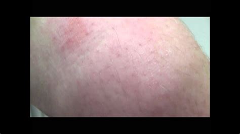 A Case Of Ringworm A Common Fungal Skin Infection Youtube