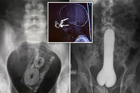 x ray pictures of the most embarrassing place to get something stuck have been shared by doctors