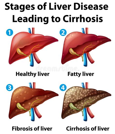 Cirrhosis Of The Liver Poster Stock Vector Illustration Of Body