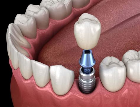 Single Tooth Implant Costs Options And Tooth Implant Faqs