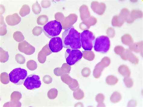 Cómo Se Diagnostica La Leucemia Mieloide Aguda Medicina Básica