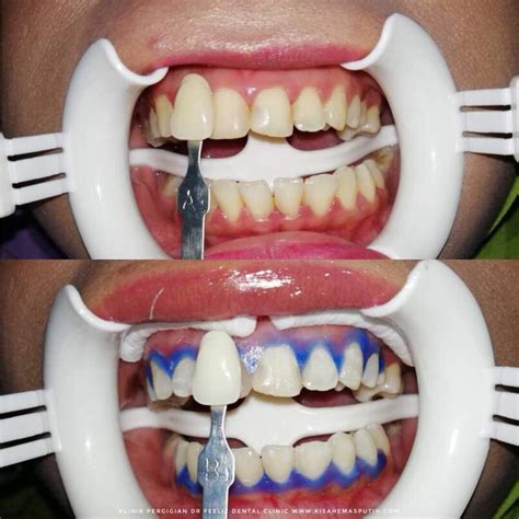 Dapatkan info mengenai perawatan gigi, termasuk harga tambal gigi, pasang crown serta perawatan gigi lainnya supaya tetap sehat. Harga Putihkan Gigi Di Klinik Kerajaan