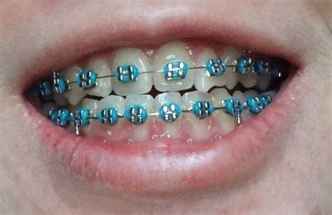 Braces Colors For Girls Teeth Somethin Different 👽 Braces Colors