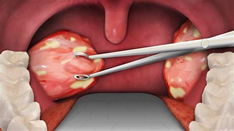 Tonsil Removal Surgery Jeffrey Decarvalho