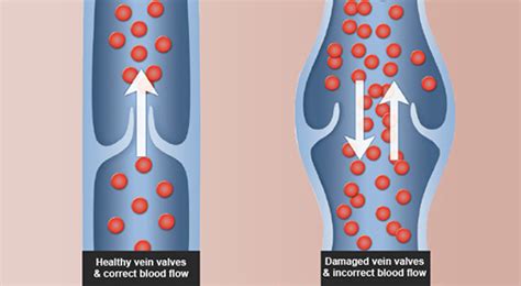 Naoum Vein Clinic Venous Reflux Disease