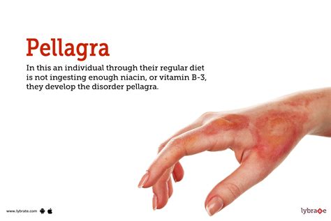Pellagra Symptoms Causes Treatment Cost And Side Effects