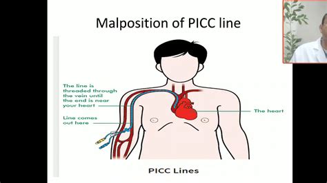 Case 31 Picc Line Malposition In Pulmonary Vein Complications Youtube