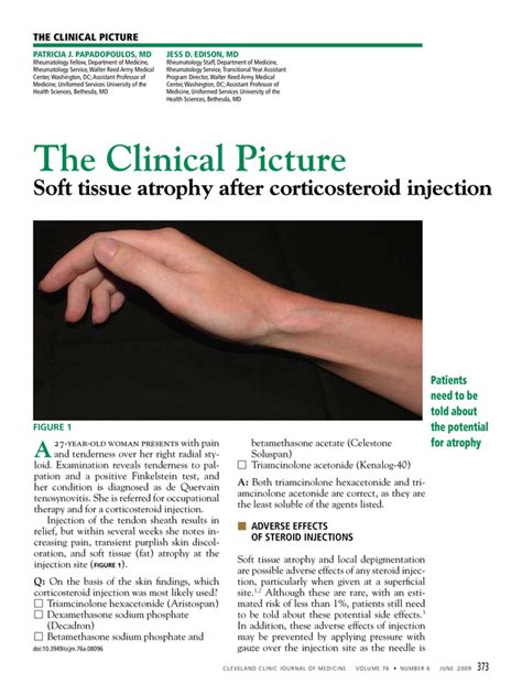 Soft Tissue Atrophy After Corticosteroid Injection Cleveland Clinic