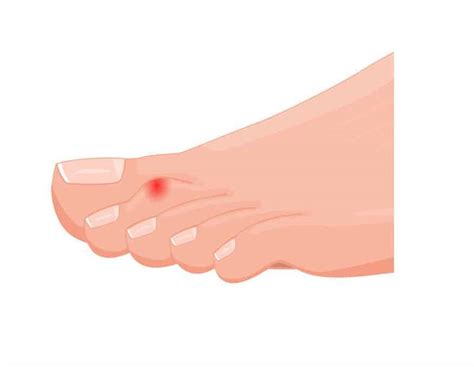 Hammer Toes Causes And Treatment Dynamic Podiatry