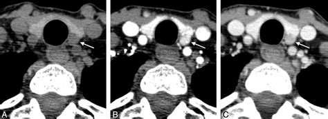 Diagnostic Accuracy Of 4d Ct For Parathyroid Adenomas And Hyperplasia