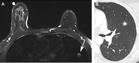 Incidental Lung Nodules On Cross Sectional Imaging Radiology Key