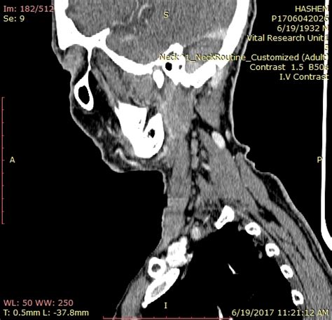 Parapharyngeal Space Mass Radiology Cervical Lymph Nodes Ct Annotated